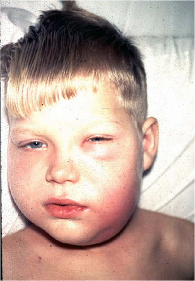 cellulitis child.jpg